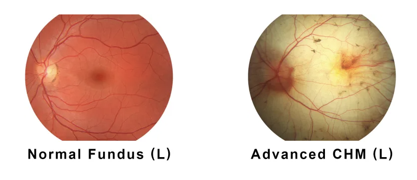 Side-by-side images of the back of the eye (fundus). The left image shows a healthy retina with normal coloring and structure. The right image shows an eye with advanced choroideremia (CHM), where large areas of degeneration and pale patches are visible.