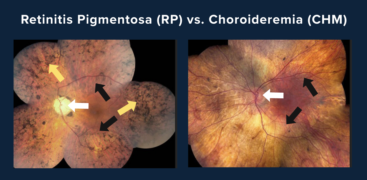 Imaging of retinitis Pigmentosa (RP) vs. Choroideremia (CHM) Later Stage.